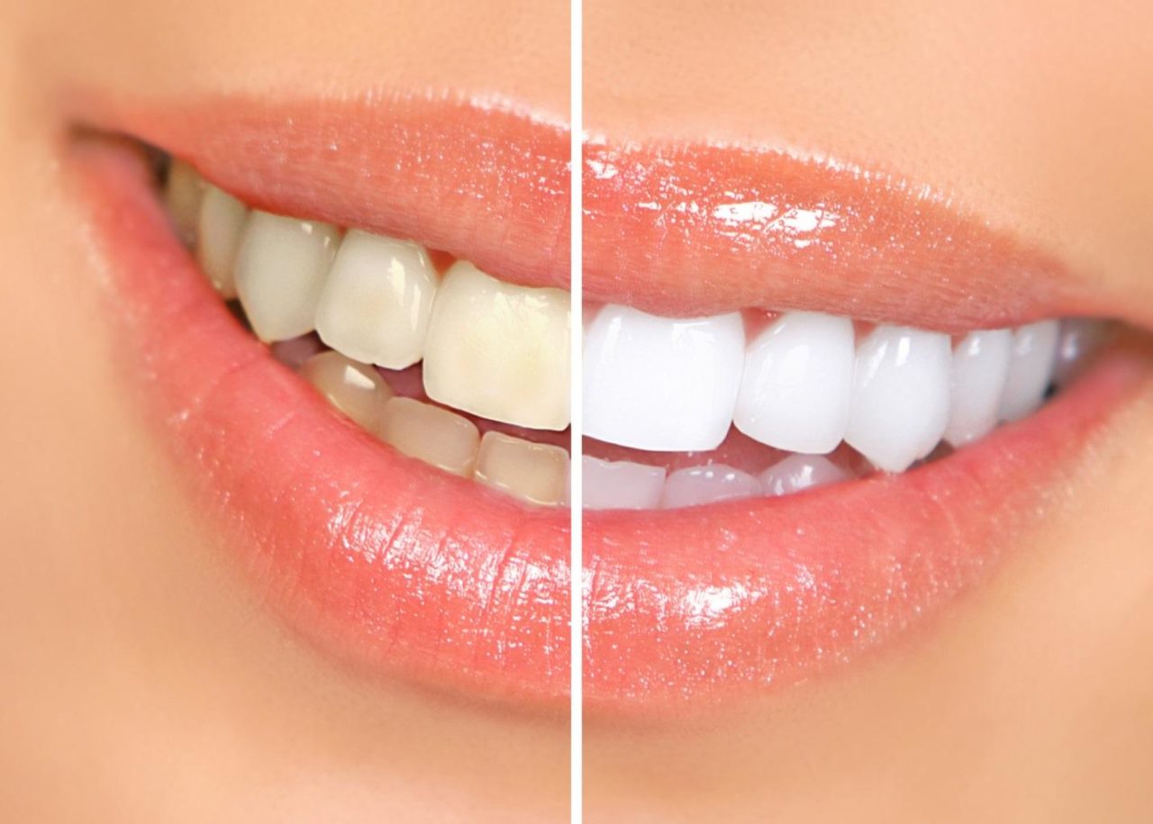 Polish Those Pearly Whites The Top 5 DIY Teeth Whitening Methods The